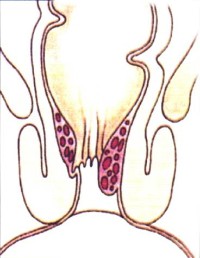 Beim zweitgradigen Hämorrhoidalleiden treten die Hämorrhoidalpolster beim Stuhlgang hervor, ziehen sich danach aber wieder zurück. Die Beschwerden nehmen insgesamt zu, eine Therapie mit Verödung, Abbindung (Ligatur), HAL oder Laser sind sinnvoll.  